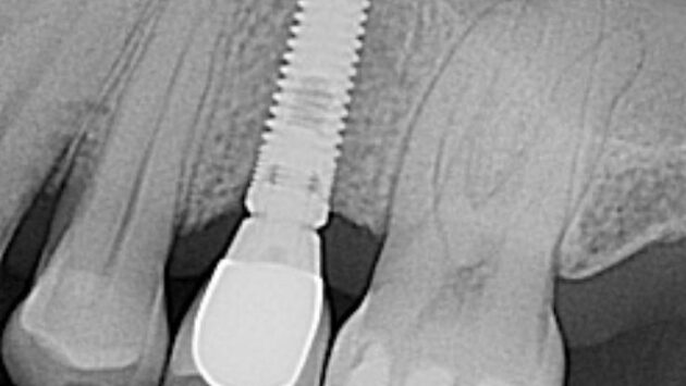 Tratamiento- Implante dental